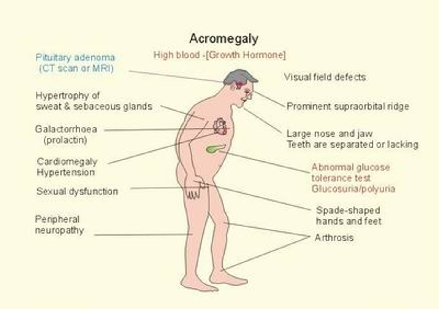 <p>The condition that results from the hypersecretion of growth hormone in adults</p>