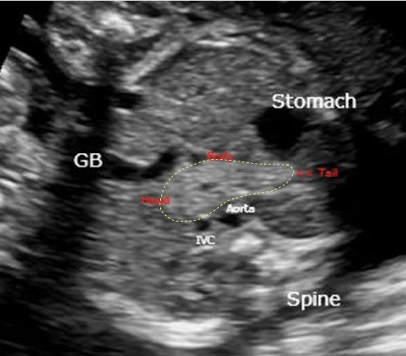 <ul><li><p>fetal pancreatic anomalies are rare</p></li><li><p>pancreatic cysts are uncommon</p><ul><li><p>when present, will appear as midline cystic mass</p></li></ul></li></ul><p></p>