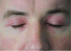 <p>What skin presentation caused by dermatomyositis is shown here?</p>
