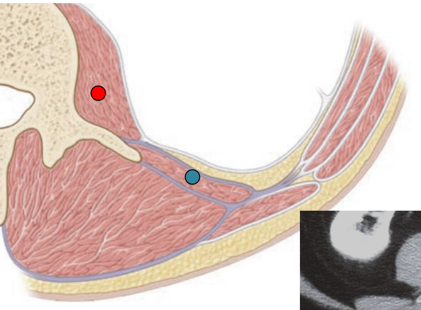 <p>Connection between back muscles, posterior abdominal wall muscles, and anterolateral abdominal wall muscles</p>