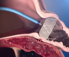 <p><span>catheter ablation therapy: thin tubes into blood vessels and guides them to the heart, scars or destroys heart tissue thats triggering the arrhythmia</span></p><p><span>maze procedure: open heart surgery, pattern of scar tissue is made in the upper chambers forcing a normal path and sinus rhythm</span></p><p><span>left atrial appendage occlusion: <strong>a minimally invasive procedure that permanently seals off the left atrial appendage</strong>—the heart pouch where most stroke-causing clots form in patients with atrial fibrillation, watchman device is placed that slowly grows into the endothelium preventing clots from getting out preventing strokes</span></p>