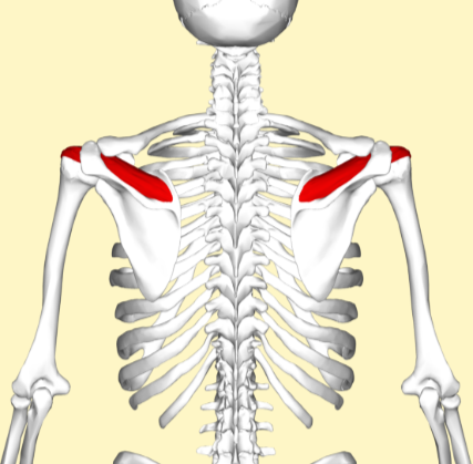 <p>this is a tear of the suprasinatus tendon- one of the four rotator cuff tendons</p>