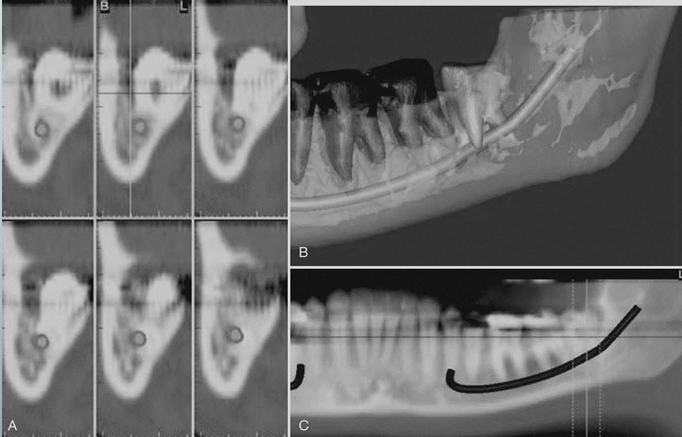 <p>-A is a cross-sectional view</p><p>-B is third-party software used to demonstrate the location of the inferior alveolar canal to an impacted third molar in 3D images</p><p>-C is an MPR reformatted image using proprietary software demonstrating the proximity of the root of an unerupted and impacted third molar associated with the IA canal</p>