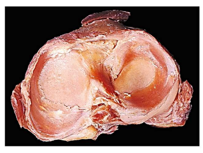 <p>Label the following:</p><ul><li><p>articular surface of tibia</p></li><li><p>meniscus</p></li></ul><p></p>