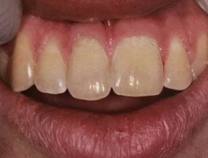 <p>large teeth, isolated is more common, usually incisors and canines (can be bilateral)</p>