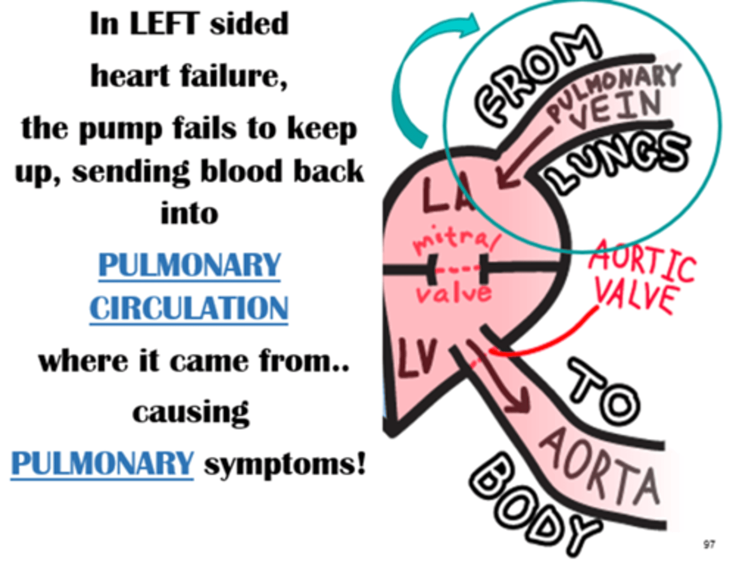 <p>A) The left side of the heart fails to pump blood to the body, so it backs up and goes to the lungs</p>