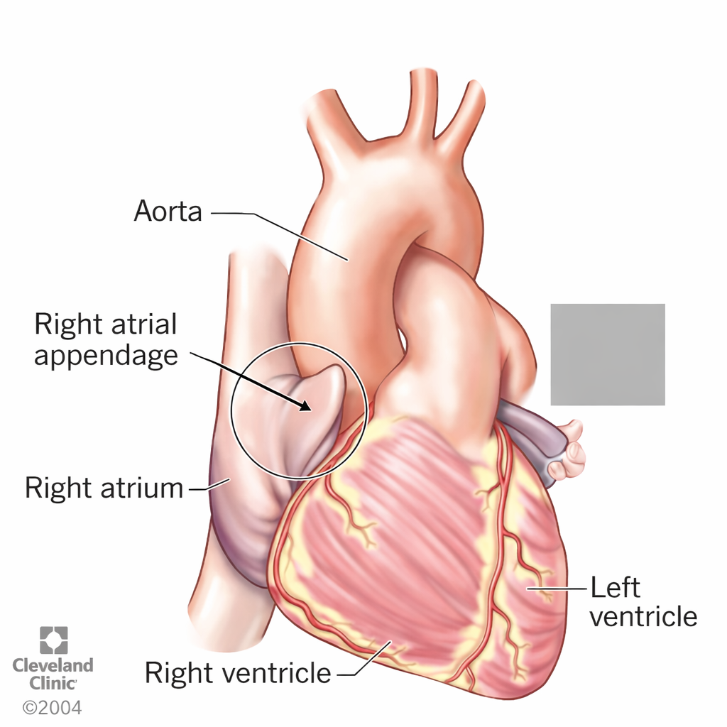 <p>Feature; elephant ear, chunky nub on top of Left atrium</p><p>on pt L side more thick</p><p>H5</p><p>14</p>