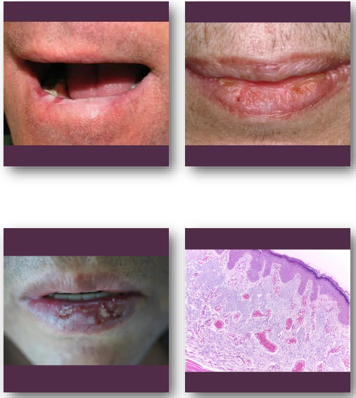 <p>•<strong>Biopsy recommended for suspicious or persistent areas</strong></p><p>•<strong>Sun protection is essential </strong>preventive measure</p><p>•Topical therapy or surgical treatment may be used</p><p>•Regular follow-up required due to cancer risk</p><p>•Risk of progression to squamous cell carcinoma</p>