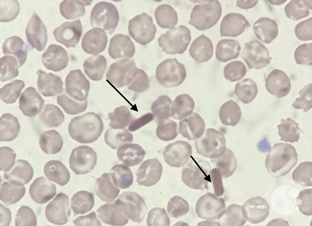 <p>Rod-like or angular Opaque Structures of Crystallized Hemoglobin</p>