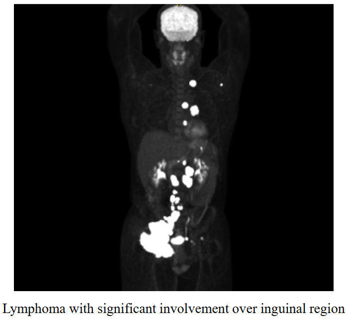 <p>PET Scan: staging</p>