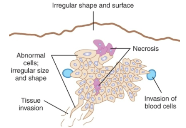 <p>Cell appearance: anaplastic (abnormal), non-functional cells</p><p>Replication: uncontrolled division</p><p>encapsulation: not encapsulated </p><p>invasion: penetrates  nearby tissues</p><p>Metastasis: more likely to metastasize</p>