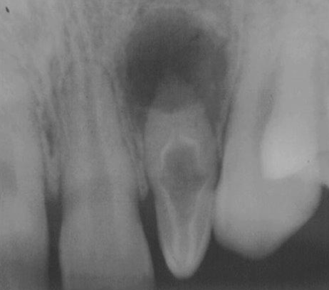 <p>What is the anatomical variation in this lateral incisor?</p>
