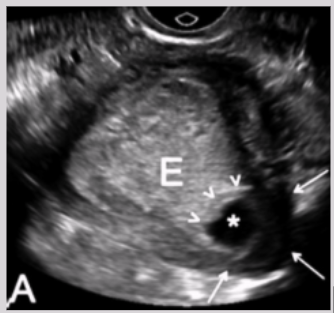<ul><li><p>Occurs in uterine horn</p></li><li><p><span style="background-color: transparent;">High susceptibility of rupturing&nbsp;</span></p></li><li><p><span style="background-color: transparent;">Associated w/ uterine anomalies&nbsp;</span></p></li><li><p><span style="background-color: transparent;">Most deadly along w/ interstitial</span></p><ul><li><p><span style="background-color: transparent;">High vascularity from UT arteries</span></p></li></ul></li></ul><p></p>