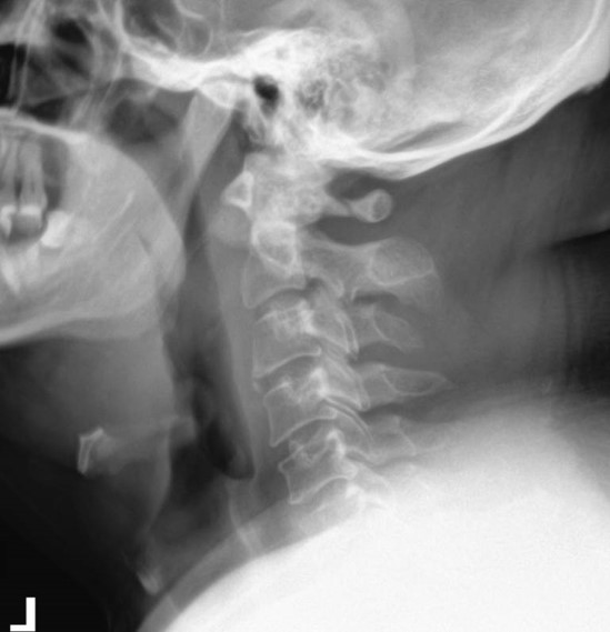 <p>What is the diagnosis and what is the mechanism of injury?</p>