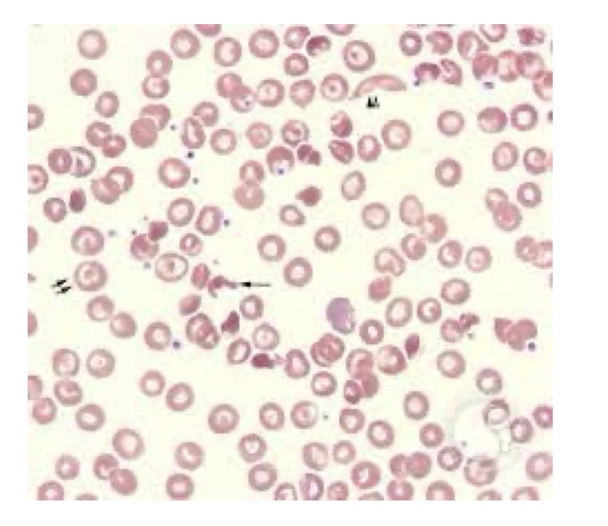 <p>What is hemoglobin SC</p>