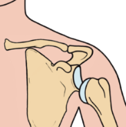 <p><span style="background-color: transparent;"><strong>What is the name of the injury shown in the picture below?</strong></span></p>