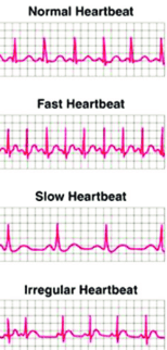 <ol><li><p>normal: 60-100 bpm</p></li><li><p>tachycardia: more than 100 bpm</p></li><li><p>bradycardia: less than 60 bpm</p></li><li><p>arrhythmia: irregular</p></li></ol><p></p>
