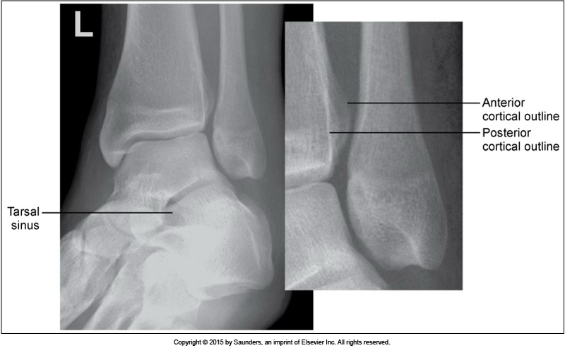 <p>AP ankle oblique (45 deg)</p>