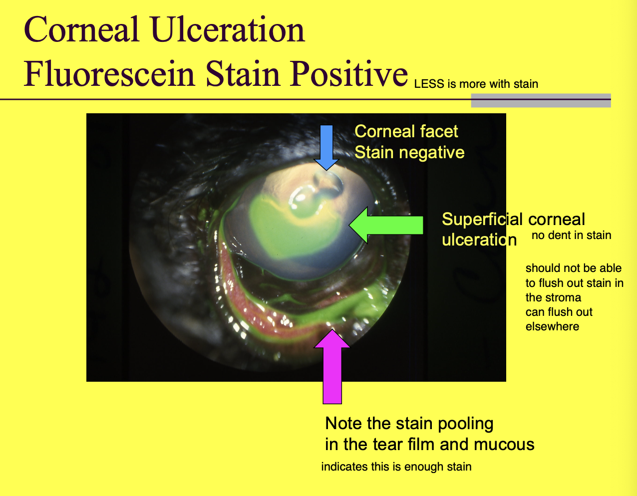 <p>positive fluorescein stain</p>
