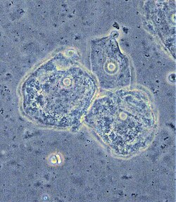 <p>Infectious vaginitis that is most commonly due to Gardnerella Vaginalis </p><p>-Presentation: white homogenous vaginal discharge, fishy odor that is exacerbated by menses/intercourse</p><p>-Physical Exam: “spilled milk over the tissue” white discharge, no erythema or inflammation of vaginal mucosa </p><p>-Dx: wet mount shows clue cells, vaginal pH > 4.5, and gram stain is gold standard </p><p>-Tx: Metronidazole </p>