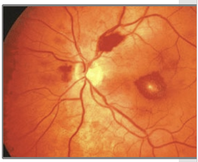 <ul><li><p>Intraretinal hemorrhages</p></li><li><p><strong>Roth spots</strong></p></li><li><p>Cotton-wool spots</p></li><li><p>Dilated and tortuous retinal vessels</p></li></ul><p></p>