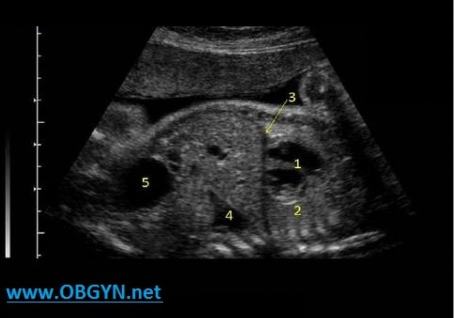 <p>#5 represents what fetal structure?</p><p>A. hydronephrosis</p><p class="p1">B. lung tissue</p><p class="p1">C. urinary bladder</p><p class="p1">D. stomach</p>