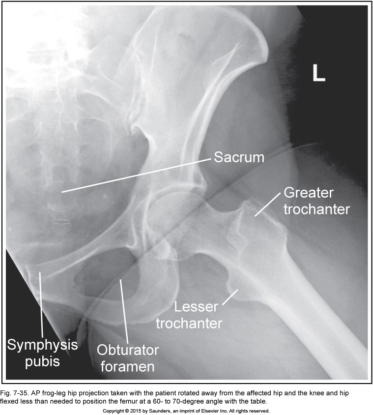 <p>AP frog leg (modified cleaves)</p>