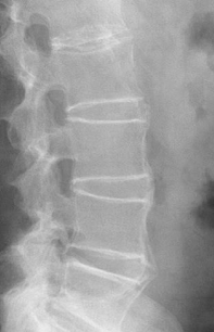 <p>Ankylosing Spondylitis</p>