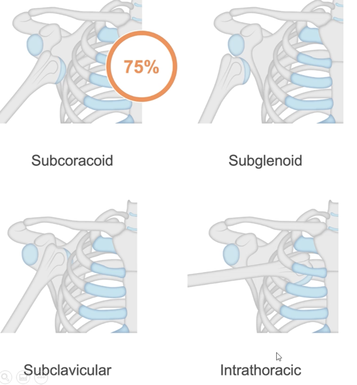 <ul><li><p><span>Classified based on where the humeral head moves to</span></p><ul><li><p><span>Subcoracoid</span></p></li><li><p><span>Subglenoid</span></p></li><li><p><span>Sub clavicular</span></p></li><li><p><span>Intrathoracic - rare</span></p></li><li><p><span>Anterior medial and inferior</span></p></li><li><p><span>Anterior more common than posterior</span></p></li></ul></li></ul><p></p>