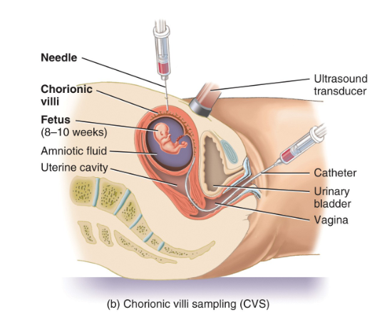 <ul><li><p>done under ultrasound guidance, but usual procedure is to insert a catheter through the vagina &amp; cervix to collect a tissue sample from the chorionic villi</p></li><li><p>goal → identify same genetic defects as seen w. amniocentesis</p><ul><li><p>procedure may be done thru the abdominal wall as w/ amniocentesis</p></li></ul></li></ul><p></p>