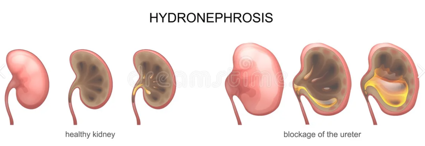 <ul><li><p><strong>swelling </strong>of kidney due to <span style="color: rgb(228, 94, 94);"><strong>buildup </strong></span>of pee when obstructed </p><ul><li><p><span style="color: rgb(190, 93, 36);"><strong>Vesicoureteral Reflux</strong></span></p></li><li><p><span style="color: rgb(190, 93, 36);"><strong>kidney stones</strong></span></p></li></ul></li></ul><p></p>