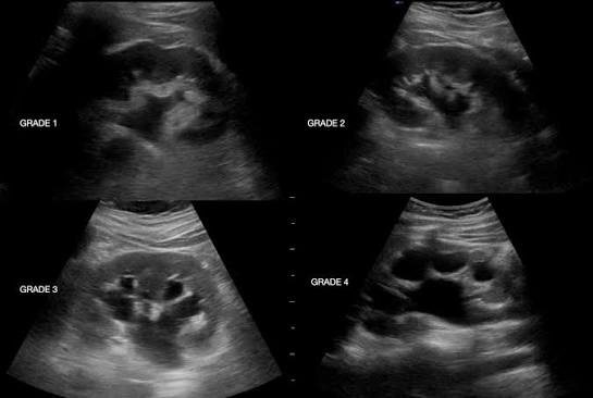 <ul><li><p>fluid-filled renal collecting system </p></li><li><p>thin parenchyma </p></li><li><p>hydroureter decrease </p></li><li><p>absent jets </p></li></ul><p></p><p>highr RI > 0.7 suggests acute urinary obstruction </p>