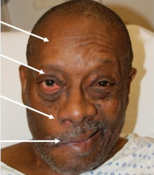 <p>What would you diagnose this man with?</p>