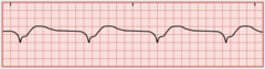 <p>Occurs when only the ventricular pacemaker is functioning. The ventricular rate ranges between 20 to 40/min and there are no discernible P waves. The QRS complex is wide and bizarre</p>