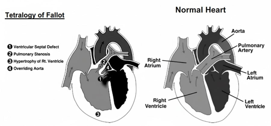 <p>Most common cyanotic CHD, which is a combination of pulmonary stenosis, RV hypertrophy, overriding aorta, and VSD</p><p>-Presentation: paroxysmal cyanosis, hyperpnea, irritability triggered by crying or feeding which is relieved by squatting </p><p>-CXR: boot-shaped heart</p><p>-Tx: complete surgical repair </p>