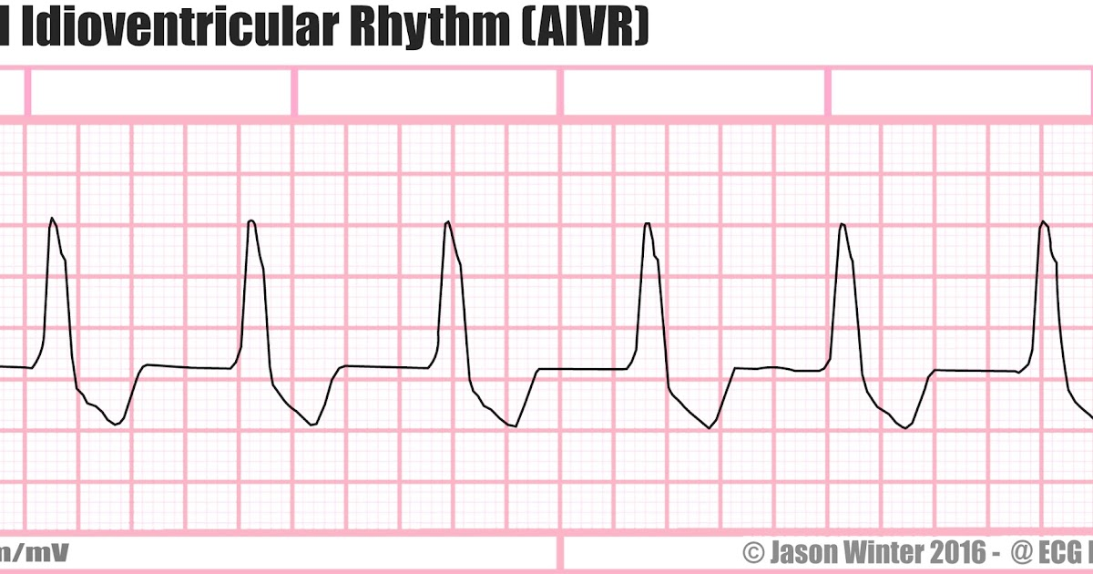 <p>Rate: 60-100</p><p>Regularity: regular </p><p>QRS > 0.12 </p>
