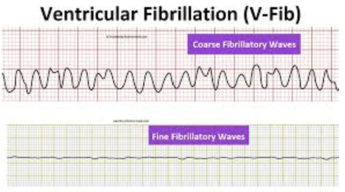 <ul><li><p><span style="background-color: transparent;">Completely abnormal</span></p></li><li><p><span style="background-color: transparent;">No rhythm</span></p></li><li><p><span style="background-color: transparent;">Coarse or fine:</span></p></li></ul><p></p>