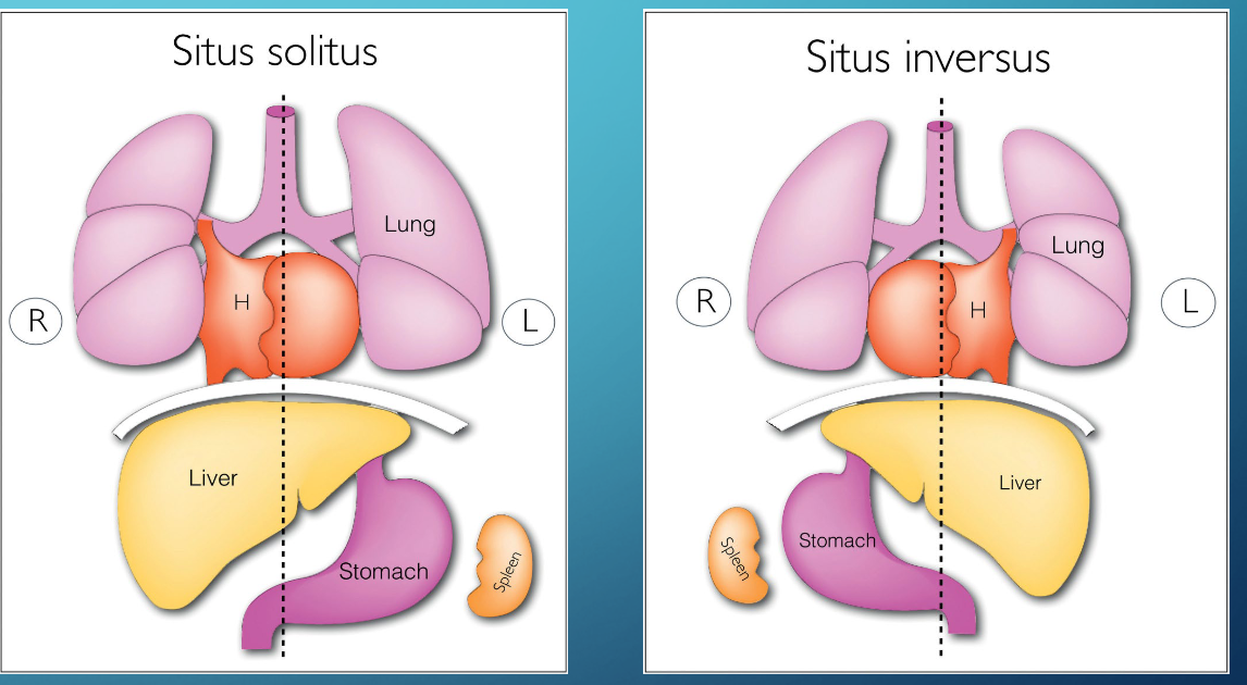 <p>condition where the positioning of</p><p>all organs is reversed in a mirror image</p><p>arrangement</p>