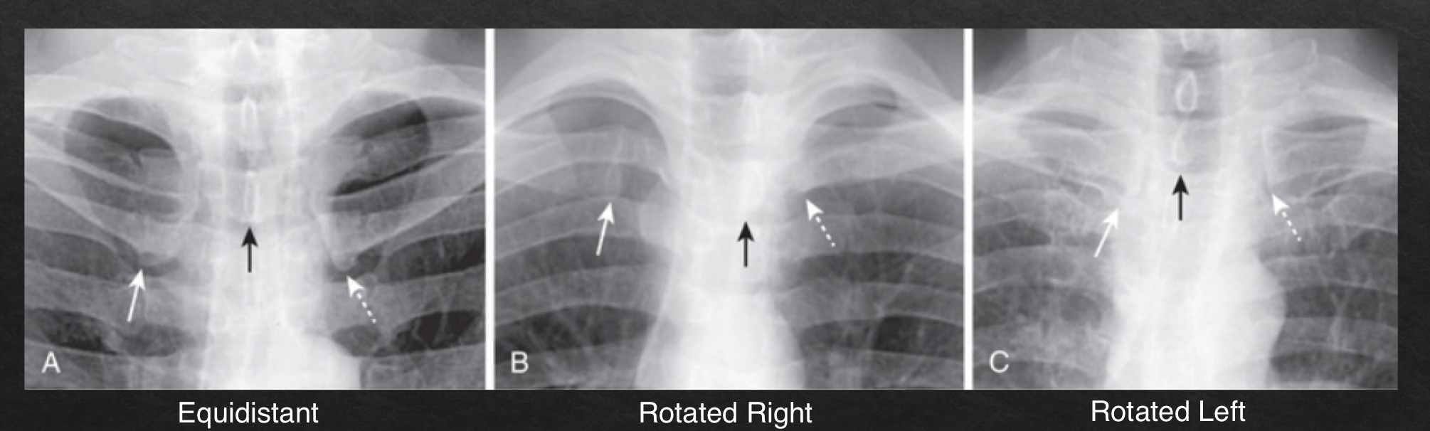<ul><li><p>adequate rotation: spinous processes are equidistant btwn the medial ends of the clavicle </p></li></ul><p></p>