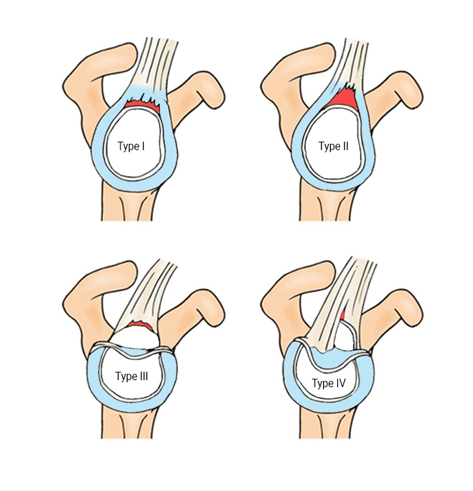 <p>bucket handle section tears away from glenoid cavity</p>