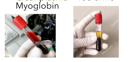 <ul><li><p>both will produce positive reagent strip blood results</p></li><li><p>1st macroscopic differentiation</p><ul><li><p>red plasma + red urine = hemoglobinuria</p></li><li><p>clear plasma + red urine = myoglobinuria </p></li></ul></li></ul><p></p>