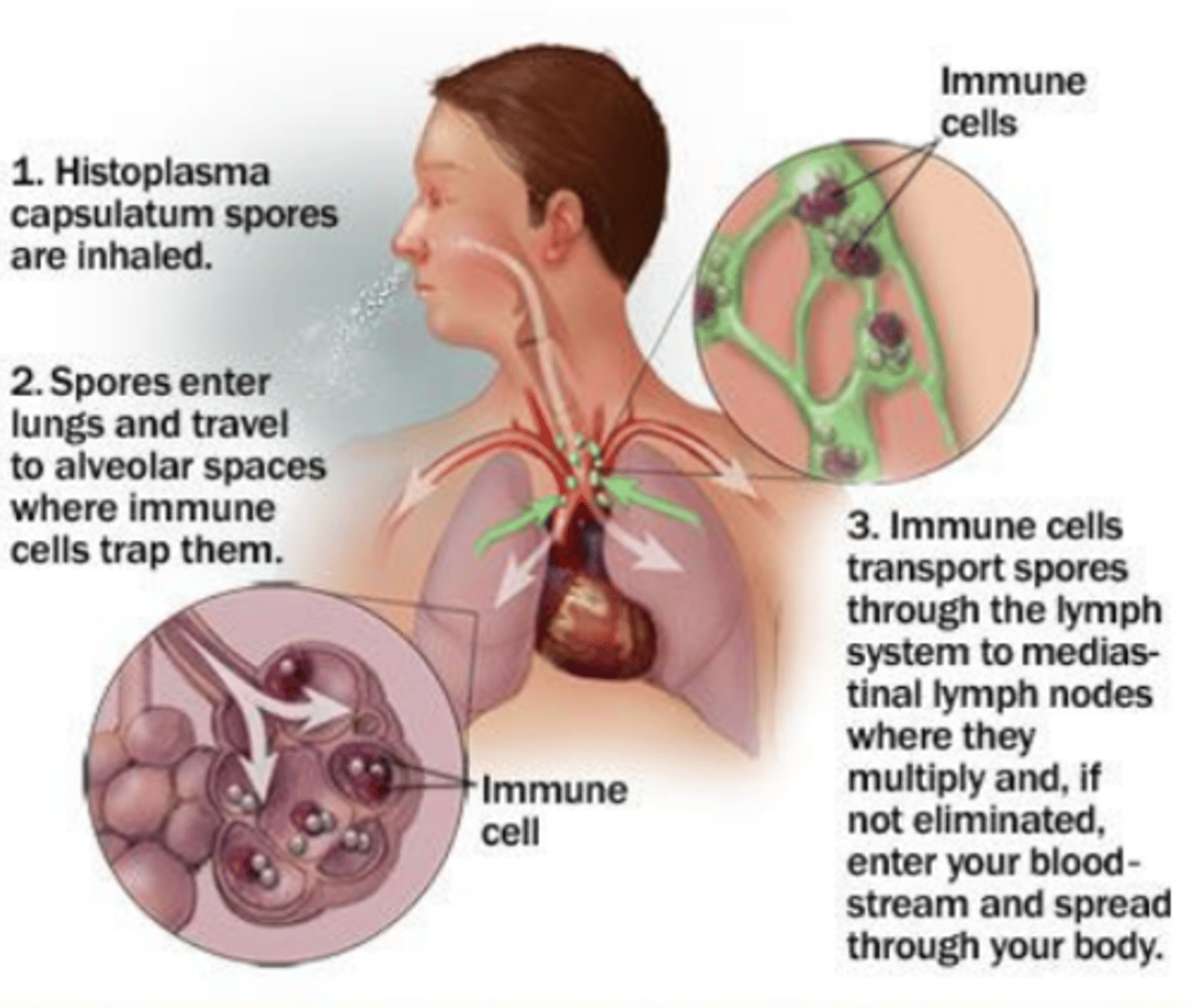 <p>- Mild to disseminated</p><p>- Asymptomatic to flu-like</p><p>- Infection of reticuloendothelial system</p><p>- Darling's disease</p><p>- Spelunker's disease</p>