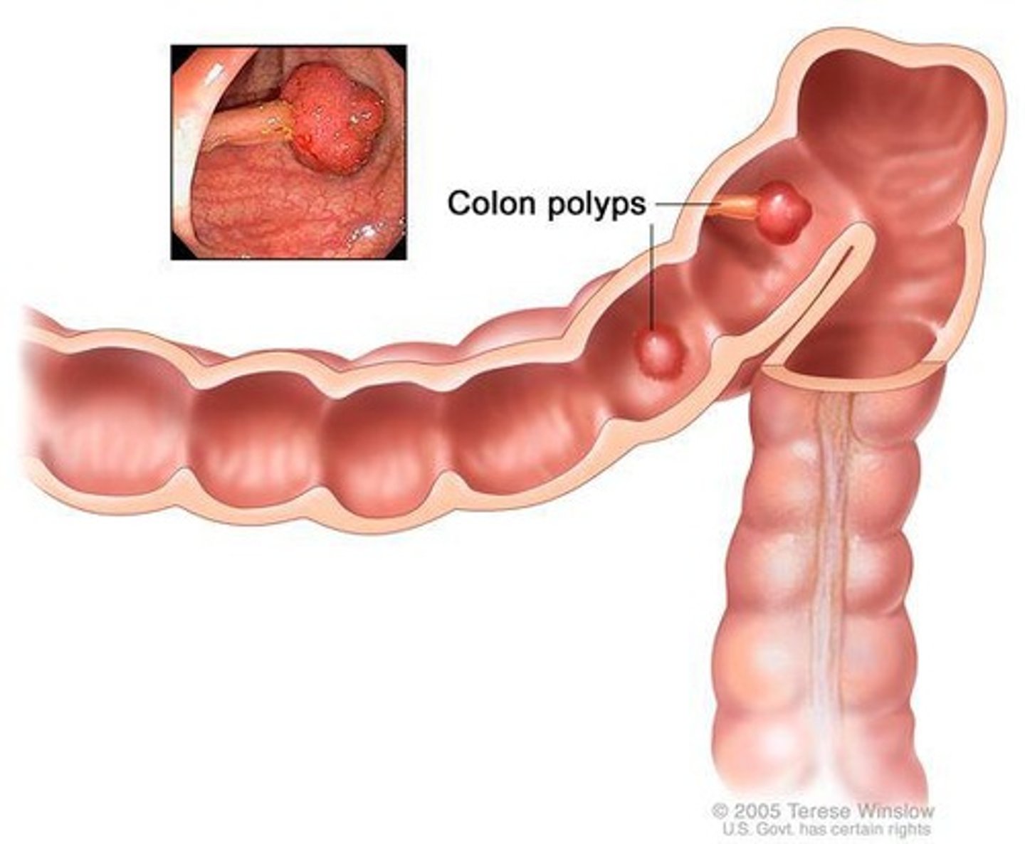 <p>Mushroom-like growth from the surface of the mucous membrane; may be benign or malignant</p>