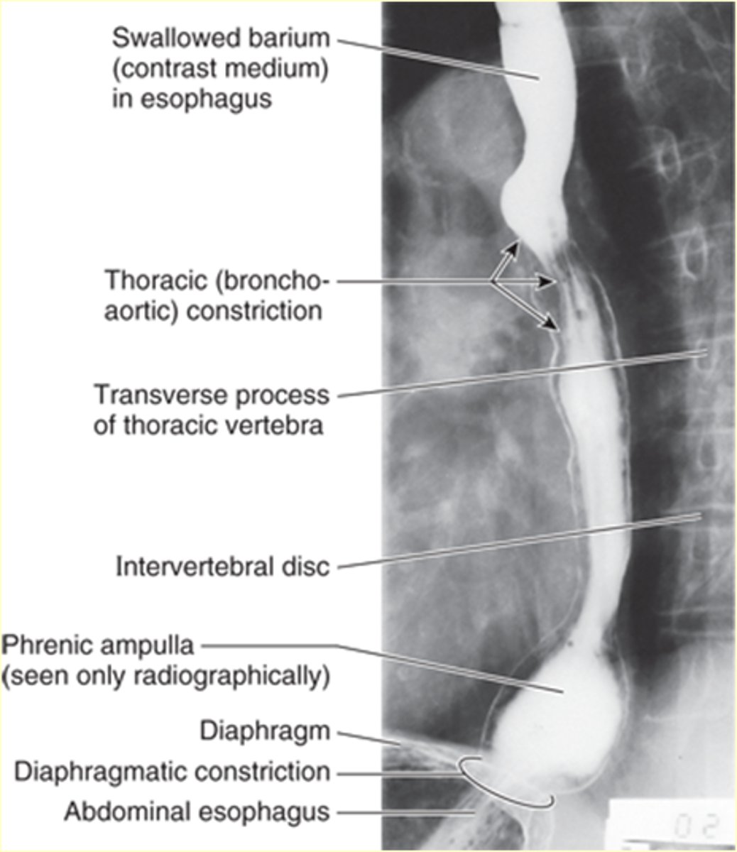 <p>Normal anatomical constriction</p>