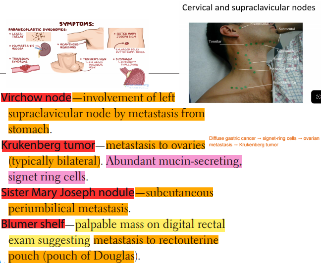 <ul><li><p><strong><u>Virchow node</u></strong> = Metastasis from stomach to left supraclavicular nodes </p></li><li><p><strong><u>Krukenberg tumor</u></strong> = Metastasis to ovaries (In Diffuse-type gastric cancer, since it’s common to find signet ring cells)</p></li><li><p><strong><u>Sister Mary Joseph Nodule</u></strong>: Subcutaneous periumbilical metastasis</p></li><li><p><strong><u>Blumer Shelf</u></strong>: Palpable mass of DGE, suggesting metastasis to pouch of Douglas</p></li></ul><p></p>