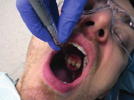 <ul><li><p>1 to 2 o’clock position</p></li><li><p>Rest ring and pinkine on right side of face, near corner of mouth</p></li><li><p>Position mirror head near the tongue</p></li><li><p>Swivel mirror head to view distal surfaces in mirror</p></li><li><p>Swivel mirror head to view lingual and mesial surfaces </p></li></ul><p></p>