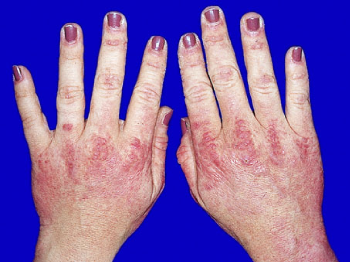<p>Photosensitive facial rash + proximal muscle weakness (climbing stairs/combing hair) + papules on dorsal hand joints -> Diagnosis and primary occult association?</p>