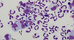 <p>What type of effusion is this?</p>