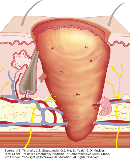 <ul><li><p>Involves entire thickness of skin </p><ul><li><p>All epidermal and dermal structures destroyed </p></li></ul></li><li><p>Typically caused by flame, hot oil, steam, contact with hot objects </p></li><li><p>Skin is charred, pale, painless, and leathery </p></li><li><p>Does not heal spontaneously </p><ul><li><p>Surgical repair and skin grafting necessary</p></li><li><p>Significant scarring always present </p></li></ul></li></ul><p></p>