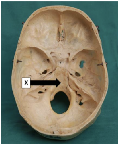 <p><span>Which structure rests at point X on the occipital bone?</span></p>
